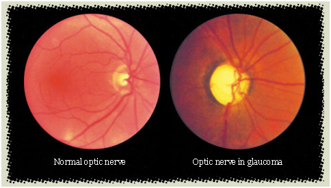 Glaucoma Detection